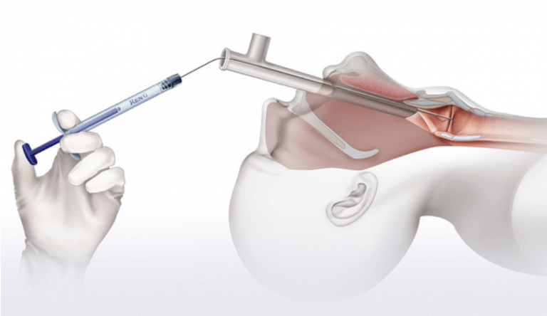 Renu Voice Injectable implant by Soluvos Medical replacement Radiesse