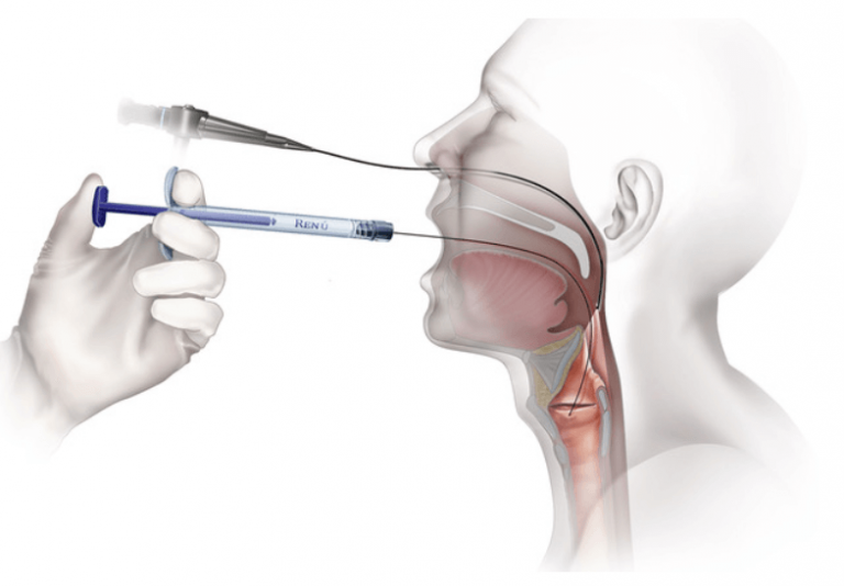 Renu Voice Injectable implant by Soluvos Medical replacement Radiesse